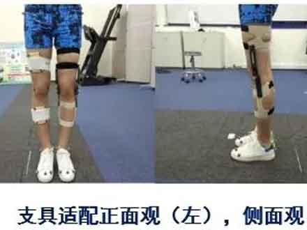 3D打印個性化膝關節矯形器