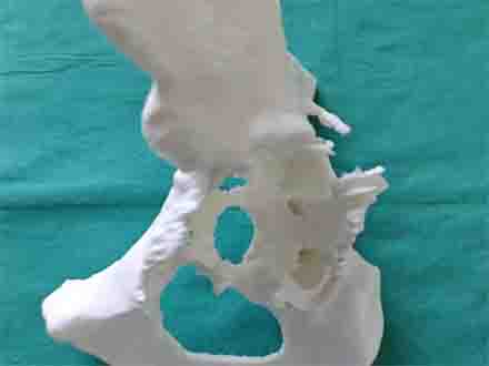 當手術遇上科技:3D打印技術遠程救治髖臼缺損患者