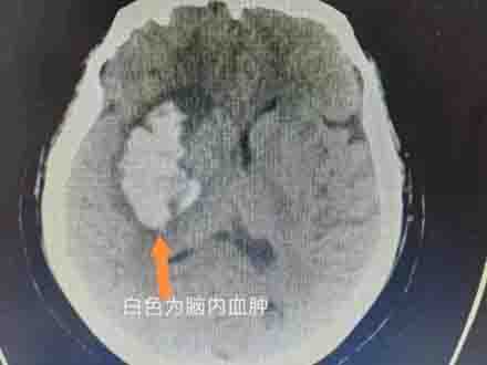 相當精準！招遠市人民醫院3D打印技術再立新功