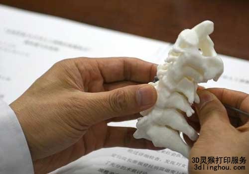 全球首例3D打印人工頸椎間盤置換術助其